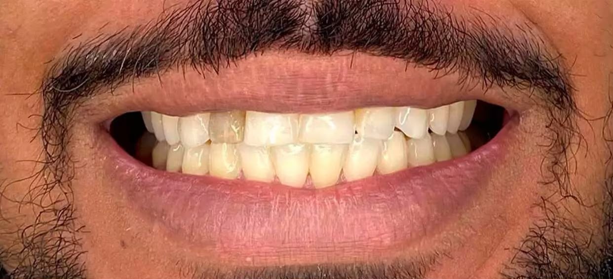 Facetas — antes