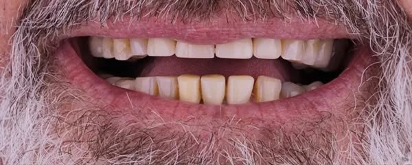 Reabilitação oral completa — antes